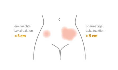 Abbildung zeigt normale und unerwünschte Reaktionen der Misteltherapie auf der Haut